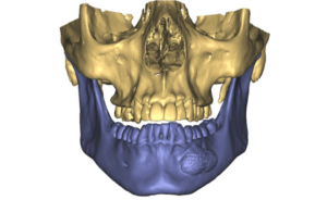 F1: LEFT mandible ameloblastoma. Resection and reconstruction using 3D printer, Proplan and patient specific PSP guides: The tumour