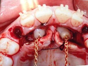 F1: Exposure of impacted maxillary canines and attachment of orthodontic gold chain