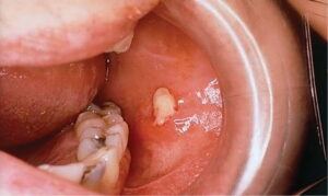 F1: Acute bacterial parotitis: Pus at the opening of the LEFT parotid salivary gland duct