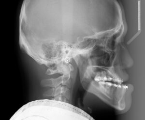 F1: Cephalometric X-Ray of a patient with a skeletal class III and prognathism