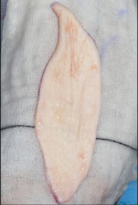 F1: Abdominal full thickness skin graft