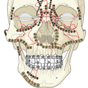 F1: Schematic representation of panfacial trauma open reduction and internal fixation with titanium mini plates. The principles of bony buttresses.