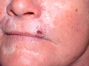 F1: BCC upper lip, marked for surgical excision