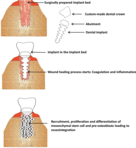 F1: Schematic representation of osseointegration