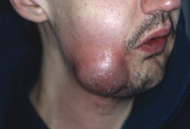 F1: Buccal abscess of dental origin, with a fluctuant point on the external skin