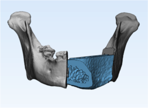 F10: LEFT mandible SCC: Resection and reconstruction using 3D printer, Proplan and patient specific PSP guides: Overview