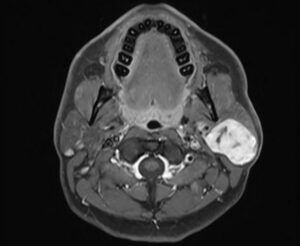 F10: MRI image of pleomorphic adenoma of the parotid salivary gland