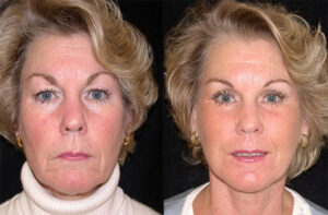 F10: Pre (LEFT) and post (RIGHT) facelift procedure