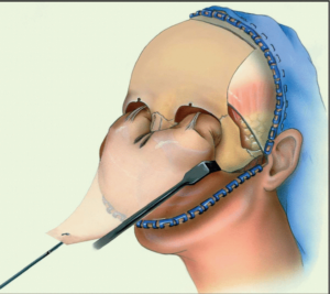 F10: The coronal flap for access to the midface: Schematic representation