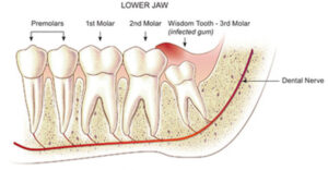 F10: Schematic representation of pericoronitis caused by an impacted wisdom tooth