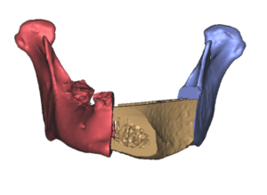 F11: LEFT mandible SCC: Resection and reconstruction using 3D printer, Proplan and patient specific PSP guides: Overview