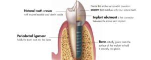 F11: Comparison of osseointegration with normal dental root anatomy