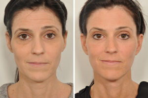 F11: Pre (LEFT) and post (RIGHT) facelift procedure