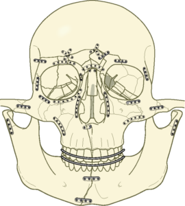 F11: Schematic representation of panfacial trauma open reduction and internal fixation with titanium mini plates. The principles of bony buttresses.