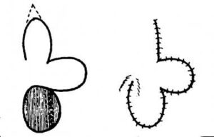 F11: Schematic representation of bi-lobed transposition flap