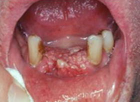 F11: Cancer of the anterior mandible