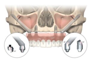 F12: Schematic considerations of zygomatic implants