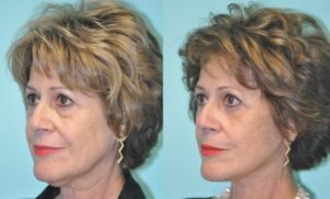 F12: Pre (LEFT) and post (RIGHT) facelift procedure