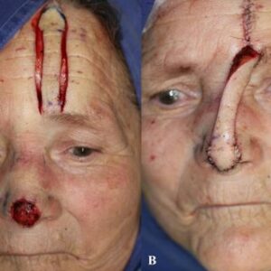 F12: Forehead pedicled flap for nasal reconstruction