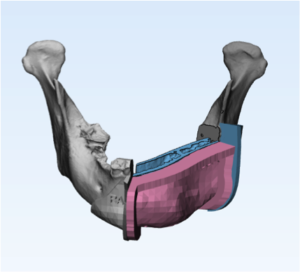 F12: LEFT mandible SCC: Resection and reconstruction using 3D printer, Proplan and patient specific PSP guides: Free flap guide