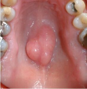 F12: Torus palatinus