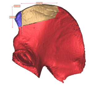 F13: LEFT mandible SCC: Resection and reconstruction using 3D printer, Proplan and patient specific PSP guides: The planned required bony segment for the DCIA free flap