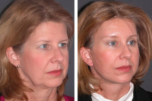 F13: Pre (LEFT) and post (RIGHT) facelift procedure