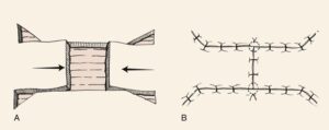 F13: Schematic representation of H-type advancement flap