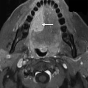 F13: MRI image of cancer on the RIGHT anterior tongue