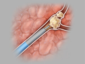 F14: Sialendoscopy – schematic