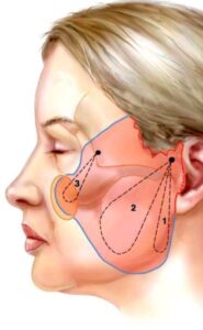 F14: Facelift procedure – pulling vectors consideration