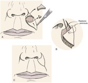 F14: Schematic representation of VY island advancement flap