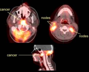 F14: PET CT image of nasopharyngeal cancer with spread to lymph nodes in both sides of the neck