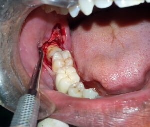 F14: Surgical extraction of impacted wisdom tooth