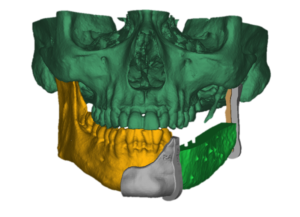 F15: LEFT mandible SCC: Resection and reconstruction using 3D printer, Proplan and patient specific PSP guides: Guides for the tumour resection