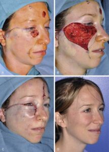 F15: Cervicofacial rotation flap following excision of cheek/lower eyelid cutaneous SCC