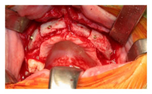 F15: Iliac crest bone graft secured in place on the recipient side maxillary alveolus with titanium screws