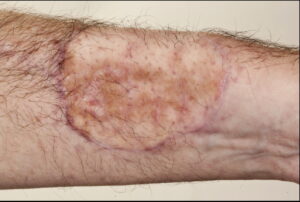 F15: Six months post repair of radial forearm free flap donor side with abdominal full thickness skin graft