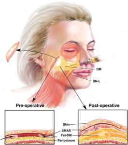 F15: Facelift procedure: The principle and philosophy of SMAS excision – placation