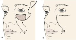 F16: Schematic representation of cheek advancement flap