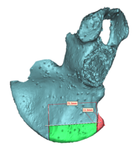 F16: LEFT mandible SCC: Resection and reconstruction using 3D printer, Proplan and patient specific PSP guides: The planned required bony segment for the DCIA free flap