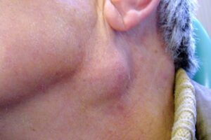 F16: Neck lump – in this case, the lump was a level II metastatic lymph node of unknown primary