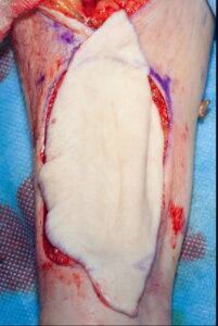 F16: Repair of radial forearm free flap donor side with abdominal full thickness skin graft