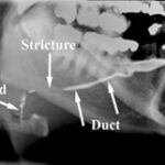 F16: Sialogram of the submandibular salivary gland – obstruction due to stricture noted