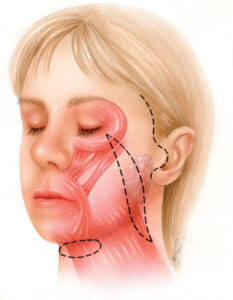 F16: Facelift and necklift procedures: SMAS and platysma simultaneous plication