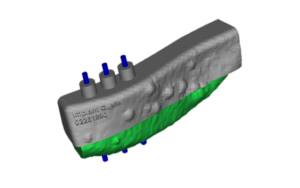 F17: LEFT mandible SCC: Resection and reconstruction using 3D printer, Proplan and patient specific PSP guides: The guide for the osseointegrated dental implants