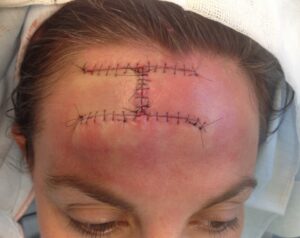 F17: H-type advancement flap in the forehead