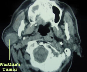 F17: MRI image of Warthin’s tumour RIGHT parotid