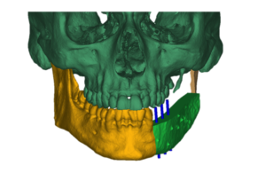 F18: LEFT mandible SCC: Resection and reconstruction using 3D printer, Proplan and patient specific PSP guides: The predicted final result