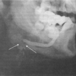 F18: Sialogram of the submandibular salivary gland – obstruction due to stone noted